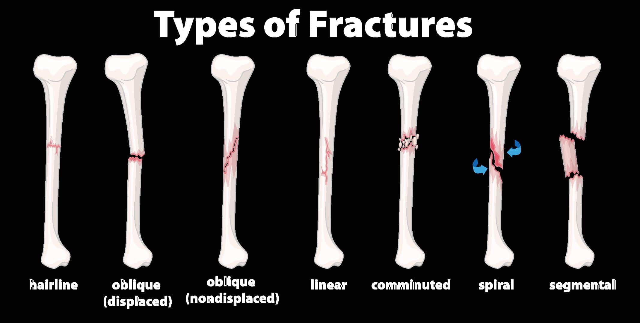 Bone Fractures: Types, Symptoms Treatment, 49% OFF