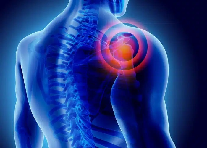 Understanding Rotator Cuff Tears: Your Path to Recovery with