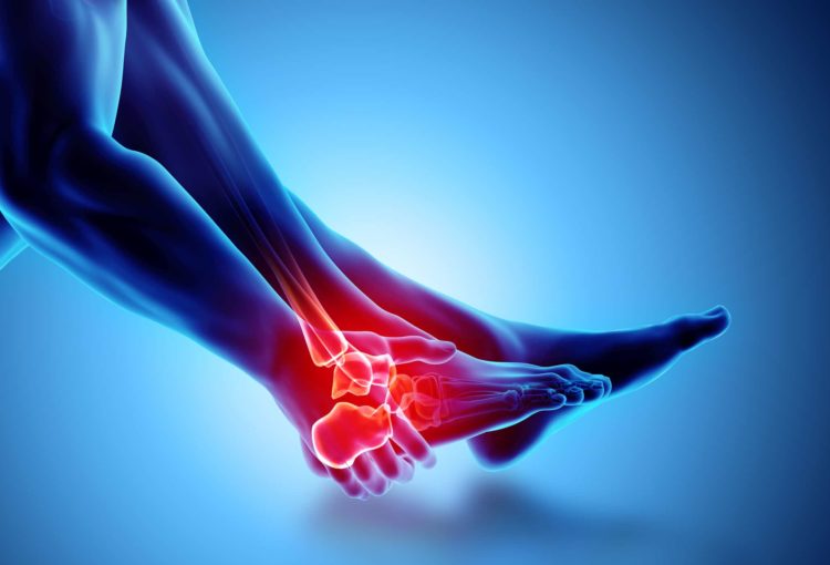 Ankle sprains: 10 things you should know