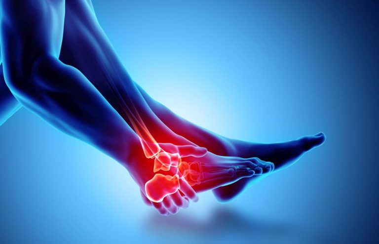 Sprained Ankles | Types, Causes & Recovery Time | OPA Ortho