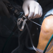 Arthroscopy: What to Expect